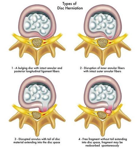 What Are The Differences Between A Herniated Disc Protrusion And Disc | Images and Photos finder