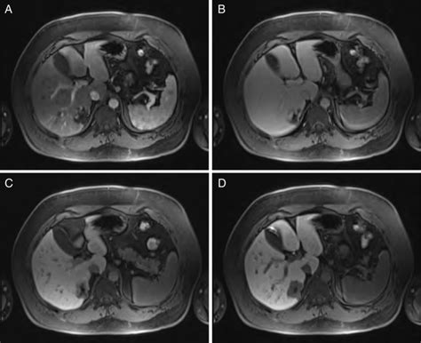 Sequential MRI imaging of hepatic hemangioma. Note delayed centripetal... | Download Scientific ...