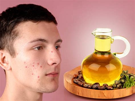 Castor oil for acne: How does castor oil help to get rid of acne from the face