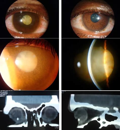 Siderosis bulbi - American Academy of Ophthalmology