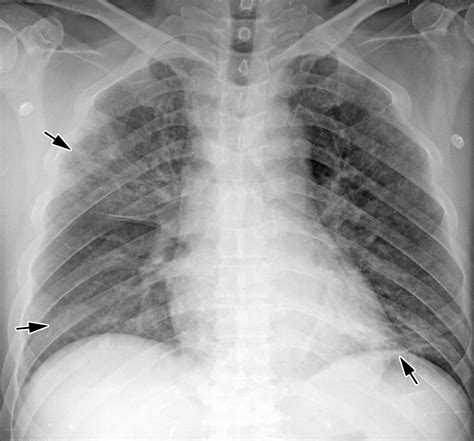 Radiographic and CT Features of Viral Pneumonia | RadioGraphics