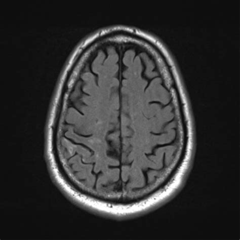 Cortical laminar necrosis | Image | Radiopaedia.org