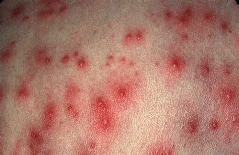 Hot Tub Rash - Pictures, Causes, Symptoms, Treatment, Complications | Diseases Pictures