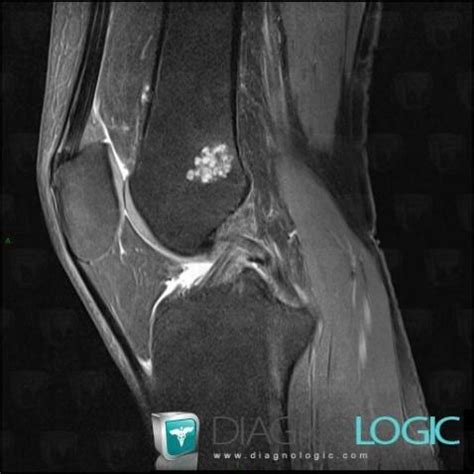 Radiology case : Enchondroma (MRI) - Diagnologic