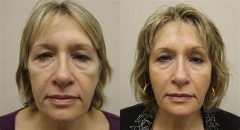 Face Filler For Marionette Lines Before and After