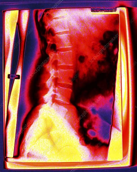 Backbone, coloured X-ray - Stock Image - C025/8323 - Science Photo Library