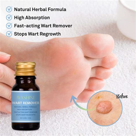 Avashine Wart Removal, Painlessly Removes Common, Hand and Plantar Wart Remover, Maximum ...