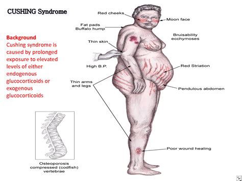 Cushing's Syndrome : Signs and symptoms of Cushing's syndrome