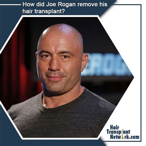 How did Joe Rogan remove his hair transplant? | Hair loss solutions, Hair loss women, Hair ...