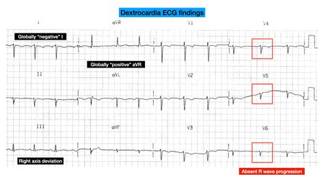 ECG Case 134 • LITFL • ECG Top 100 Self-Assessment Quiz