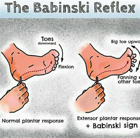 The babinski reflex | Nursing study, Nurse problems, Nurse humor