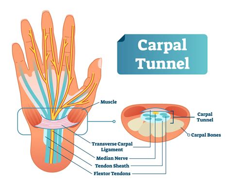 What is the Carpal Tunnel? | Arora Hand Surgery