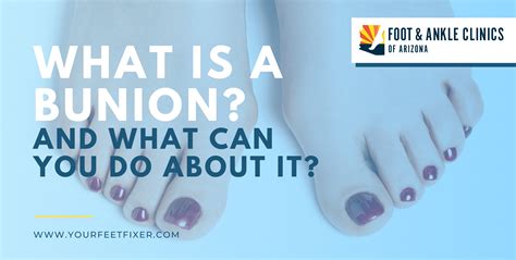 What is a Bunion (and What Can You Do About It)? - Foot & Ankle Clinics ...