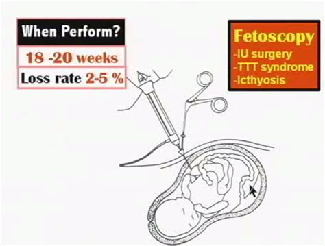 Doctors Network: Fetoscopy