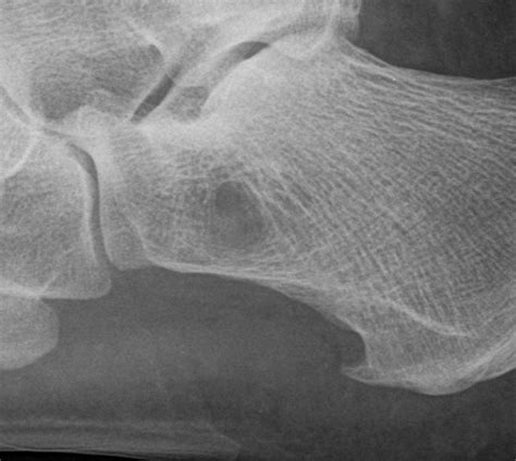 Calcaneal pseudocyst | Radiology Case | Radshare.net