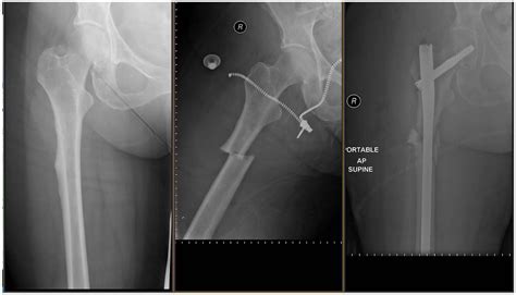 Atypical femur fractures: current understanding and approach to management - Lianne Tile, Angela ...