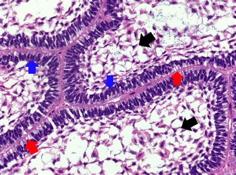 Unicystic Ameloblastoma Histology