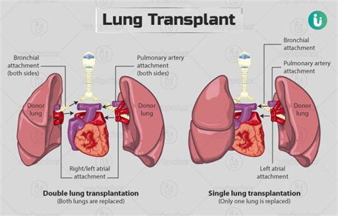 Lung transplant surgery