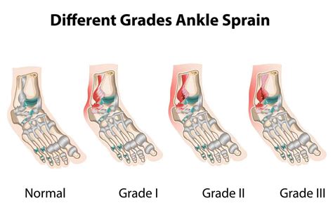 Lateral Ankle Ligament Sprains: Symptoms & Treatment – Injury Health Blog