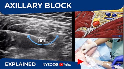 Aja detalles Transparente brachial plexus block nysora Resplandor ...