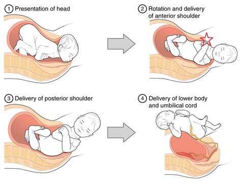 Shoulder Dystocia Delivery