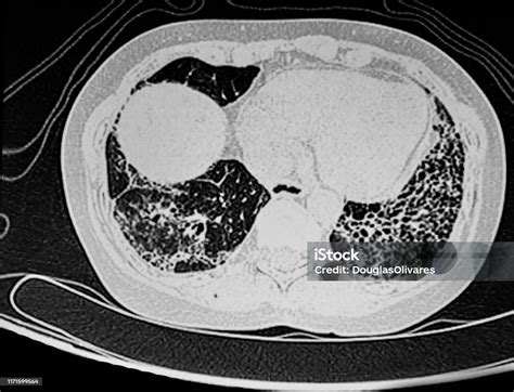 Cat Scan Showing Bilateral Bibasilar Honeycombing Stock Photo - Download Image Now - iStock