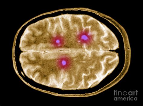 Multiple Sclerosis Brain Lesions Photograph by Scott Camazine | Pixels