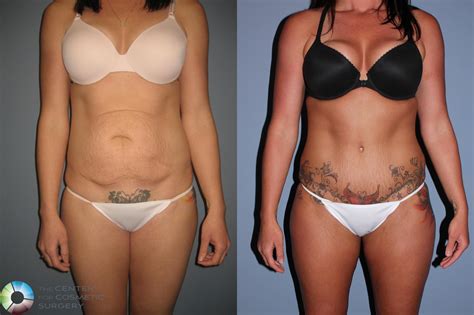 Weight Gain After Liposuction And Tummy Tuck | Blog Dandk