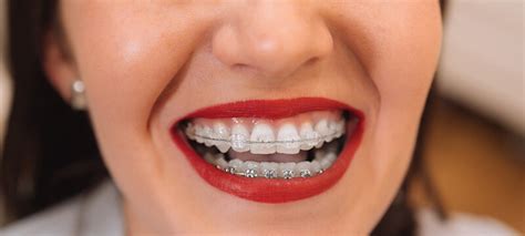 Brace Yourself for the Perfect Smile – How Braces Work | Hamburg Dental Care