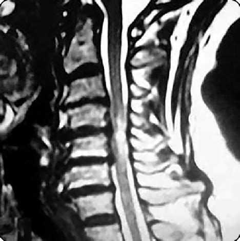 Sagittal MRI image showing myelomalacia opposite C4-C6 | Download ...