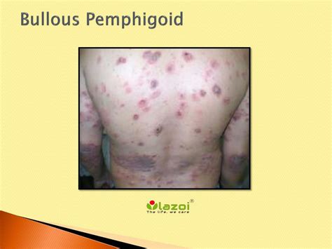 PPT - Bullous Pemphigoid PowerPoint Presentation, free download - ID ...