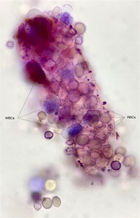 Urine Sediment of the Month: Mixed Cellular Casts - Renal Fellow Network