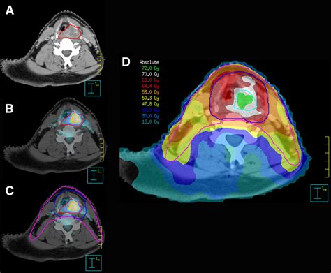 Innovations in Radiotherapy Planning of Head and Neck Cancers: Role of ...