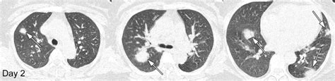 CT Scans Show What Coronavirus Did to the Lungs of COVID-19 Sufferers