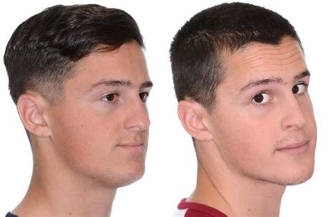 Maxillomandibular advancement with genioplasy. - Corrective Jaw Surgery ...