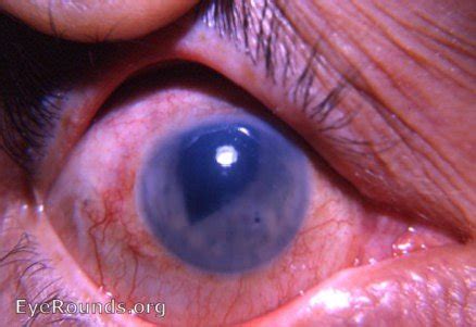 bullous keratopathy following intracapsular cataract surgery. EyeRounds ...