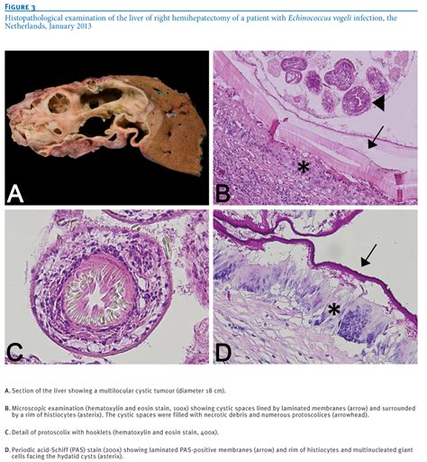 Fever as related to Echinococcus - Pictures