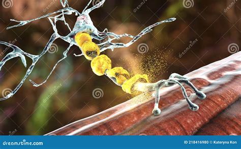 Demyelination of Neuron, the Damage of the Neuron Myelin Sheath Seen in ...