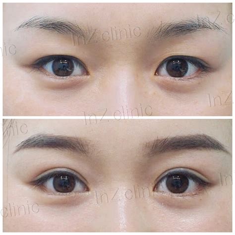 Visibly uneven eyelids : r/PlasticSurgery