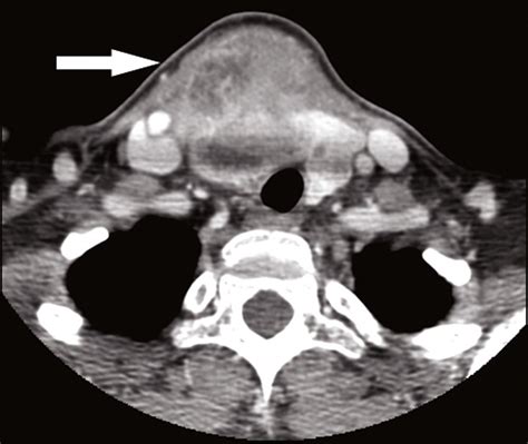 Contrast enhanced CT scan focused on the right thyroid nodule that... | Download Scientific Diagram