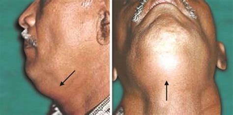 Deep neck infection causes, symptoms, diagnosis, treatment & prognosis