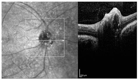 Optic Disc Drusen