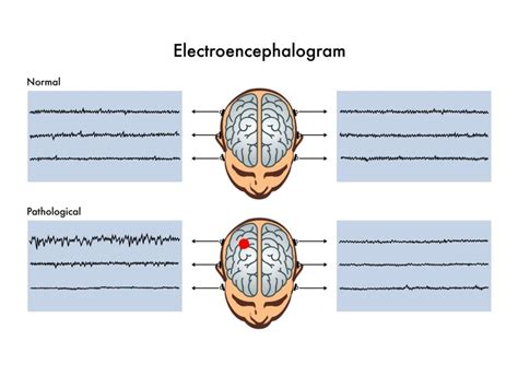 Electroencephalogram (EEG) - Dr. Raul Grosz