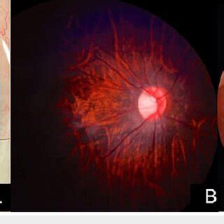 (A) Intra-operative photograph of right eye showing absent zonules in ...