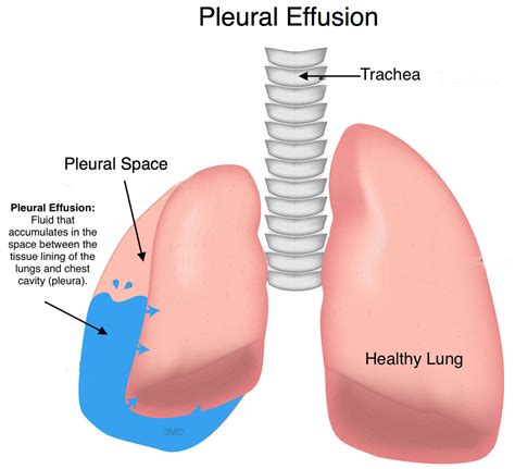 Target Liberty: Rand Paul Update: Six Broken Ribs and Fluid Around a Lung