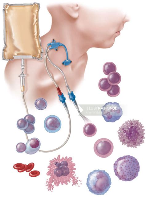 Hematopoietic Stem Cell Transplant | Illustration by Alex Webber