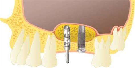 -Technique of the biopsy with trephine-type drill. | Download ...