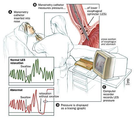 Esophageal Manometry | Johns Hopkins Division of Gastroenterology and Hepatology