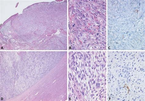 Histology of atypical fibroxanthoma (AFX: A, B, C) and undifferentiated... | Download Scientific ...