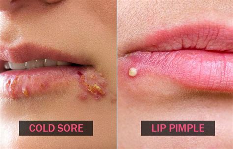 Cold Sores Vs. Pimples: How They Look, Causes, & Treatment